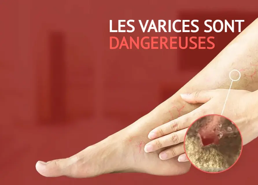 Crème Anti-Varices Venoxil